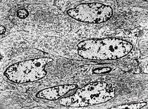F,61y. | leiomyosarcoma - axilla F,61y. | leiomyosarcoma - axilla